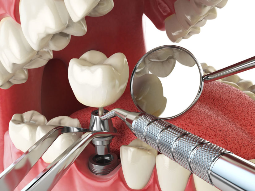 Dental Implant Pune