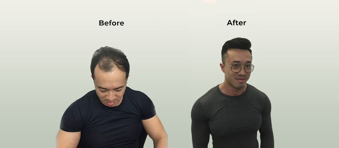 Find Men Hair Loss Solution Near Me